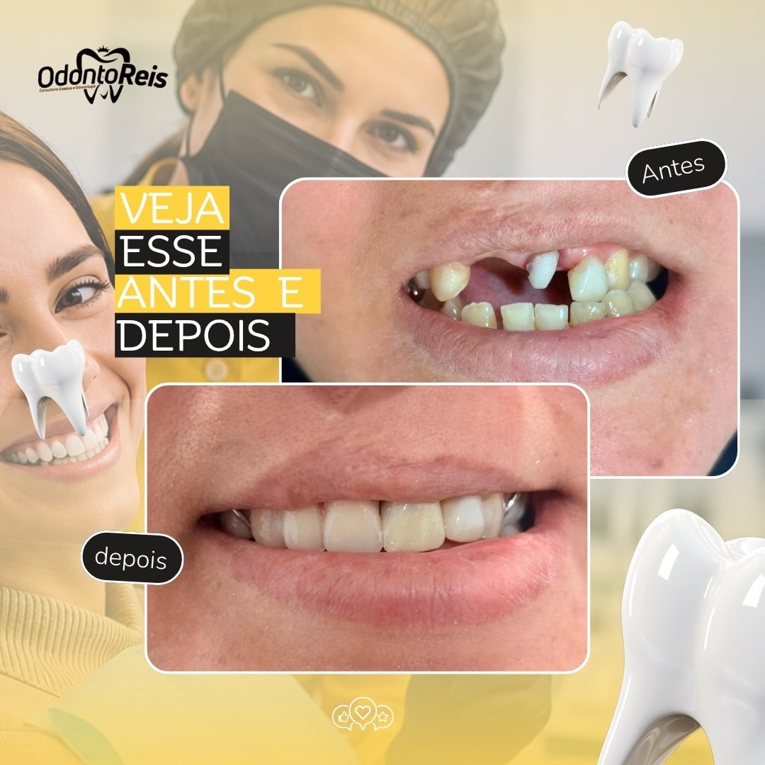 Antes e depois de reabilitação com prótese em paciente com ausência de dentes