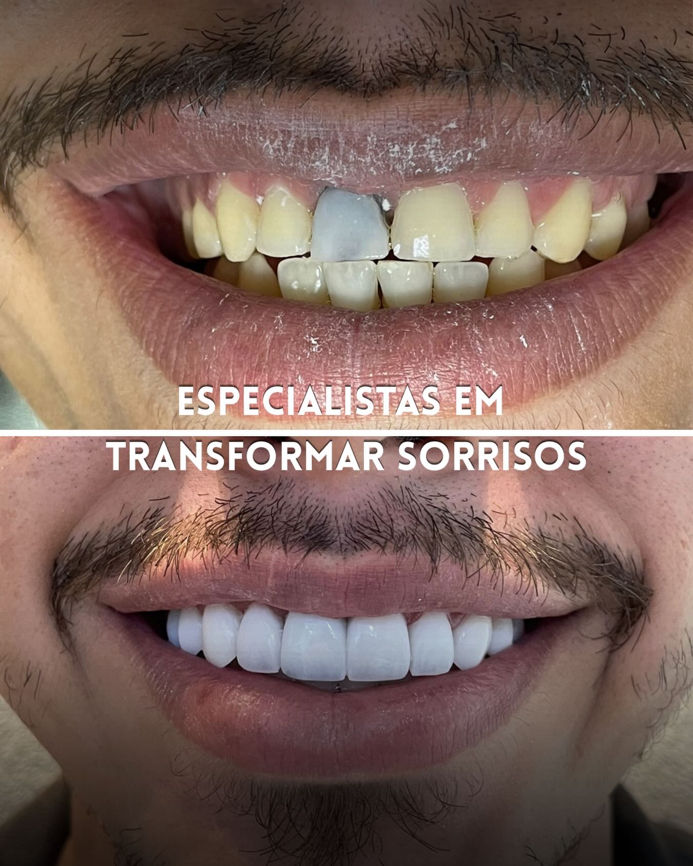 Antes e depois de facetas em resina: sorriso escurecido transformado em dentes brancos e alinhados