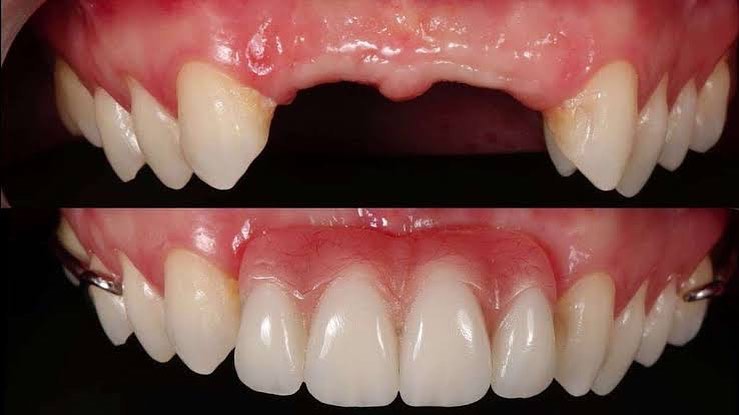 Antes e depois de implante repondo dente da frente ausente