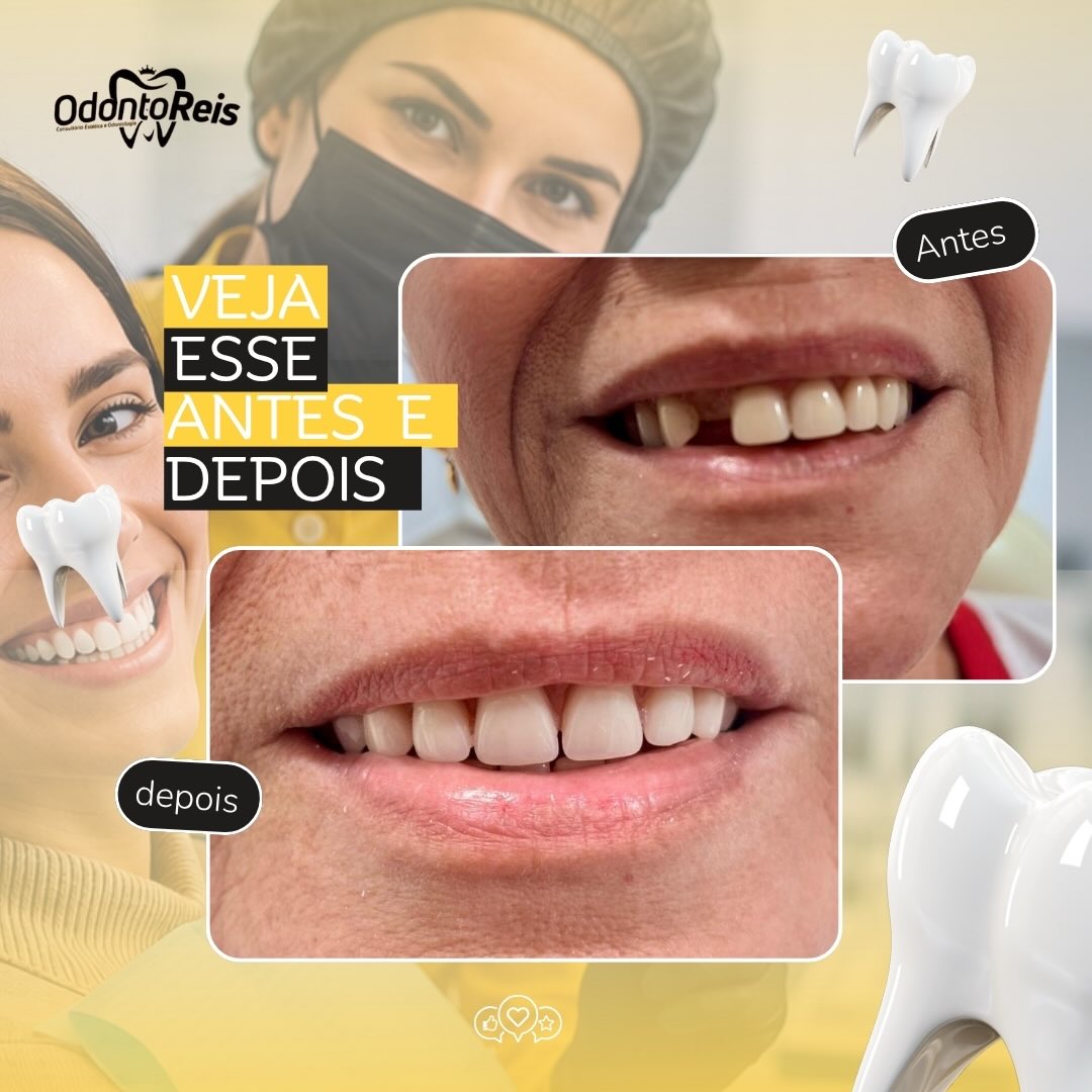Antes e depois de prótese devolvendo dentes ausentes e harmonia do sorriso