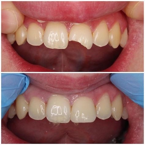Antes e depois de restauração em resina reconstruindo dente fraturado