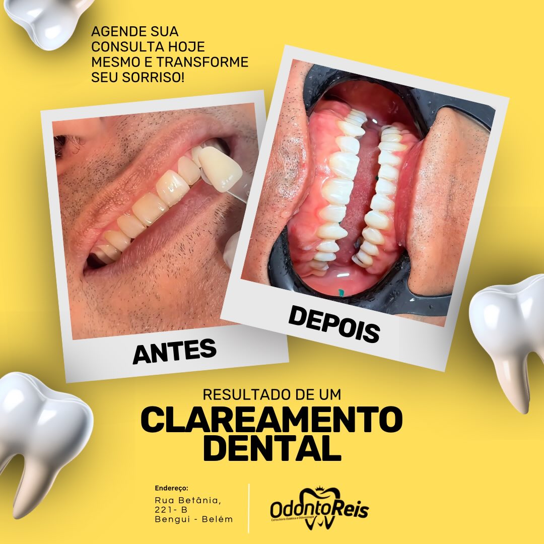 Resultado de clareamento dental antes e depois realizado na OdontoReis