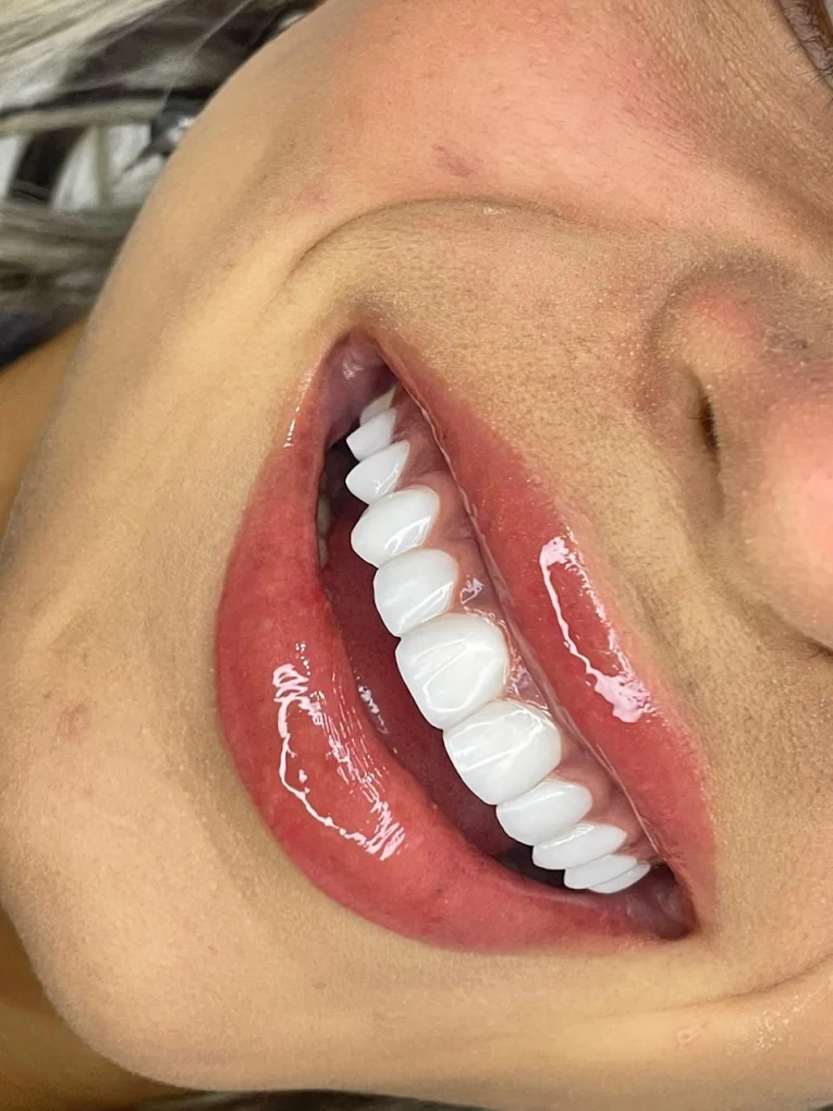 Resultado de facetas em resina: sorriso alinhado e uniforme