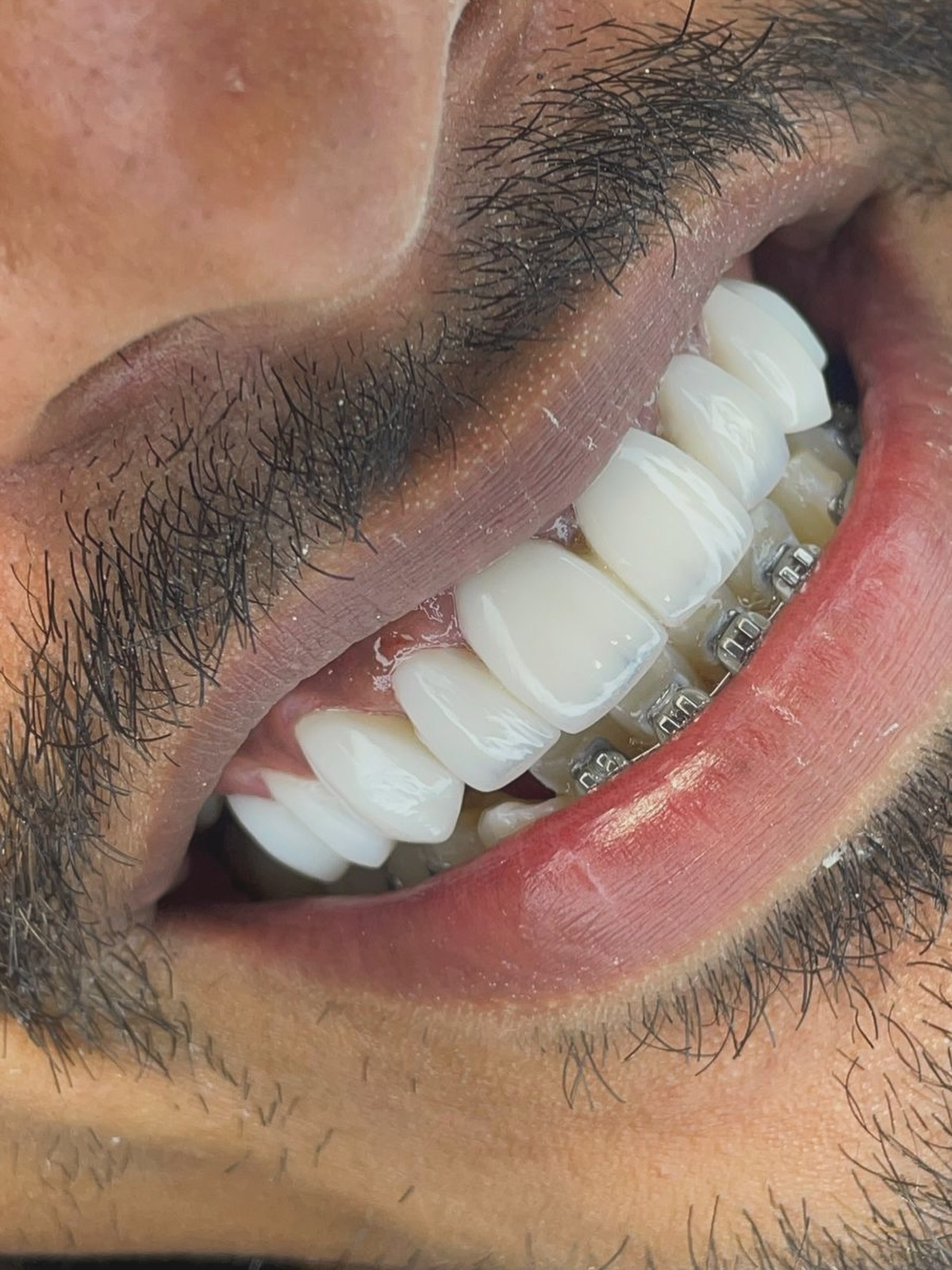 Paciente em tratamento ortodôntico com dentes superiores estéticos