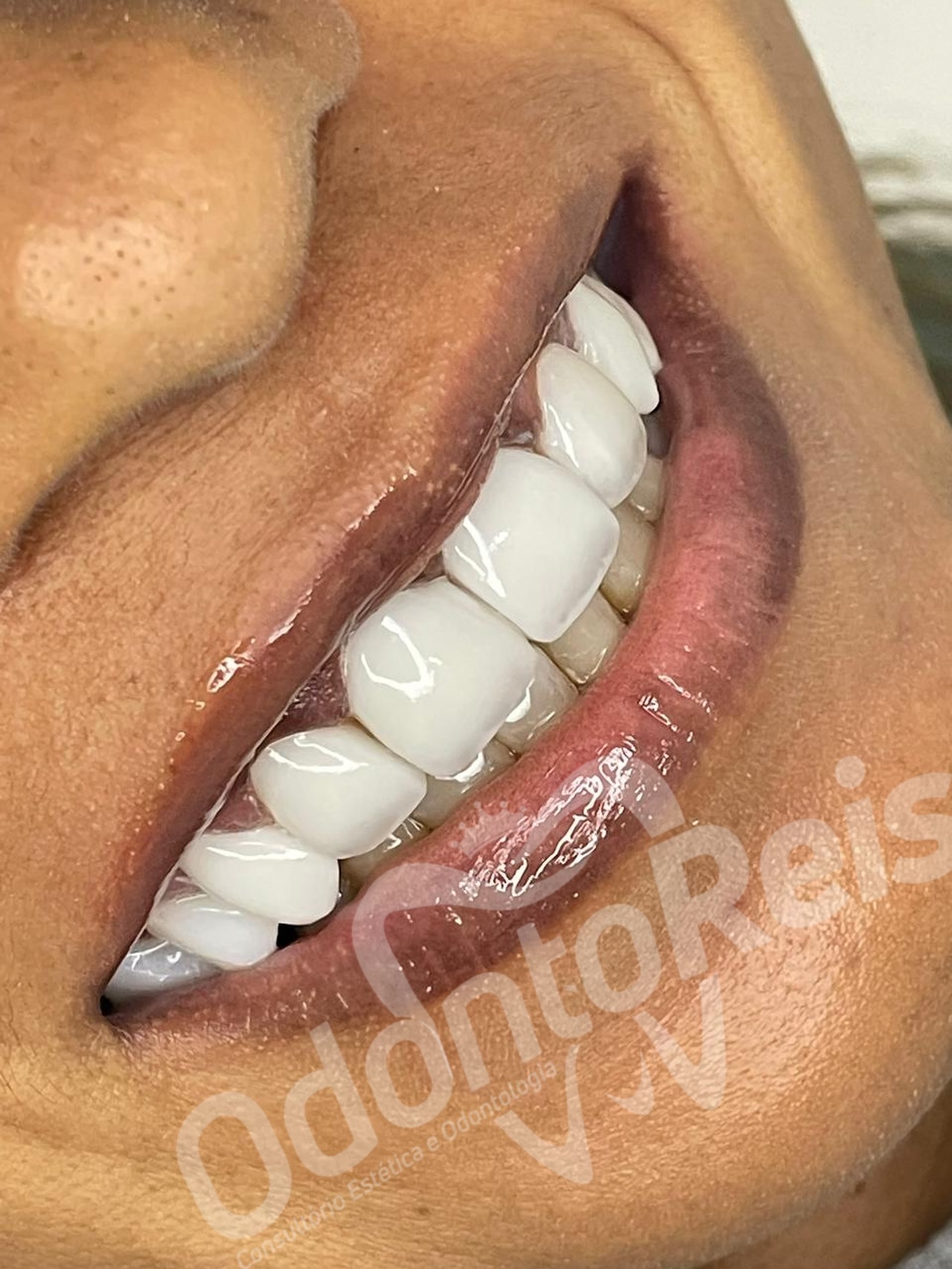 Close de facetas em resina com brilho e formato natural