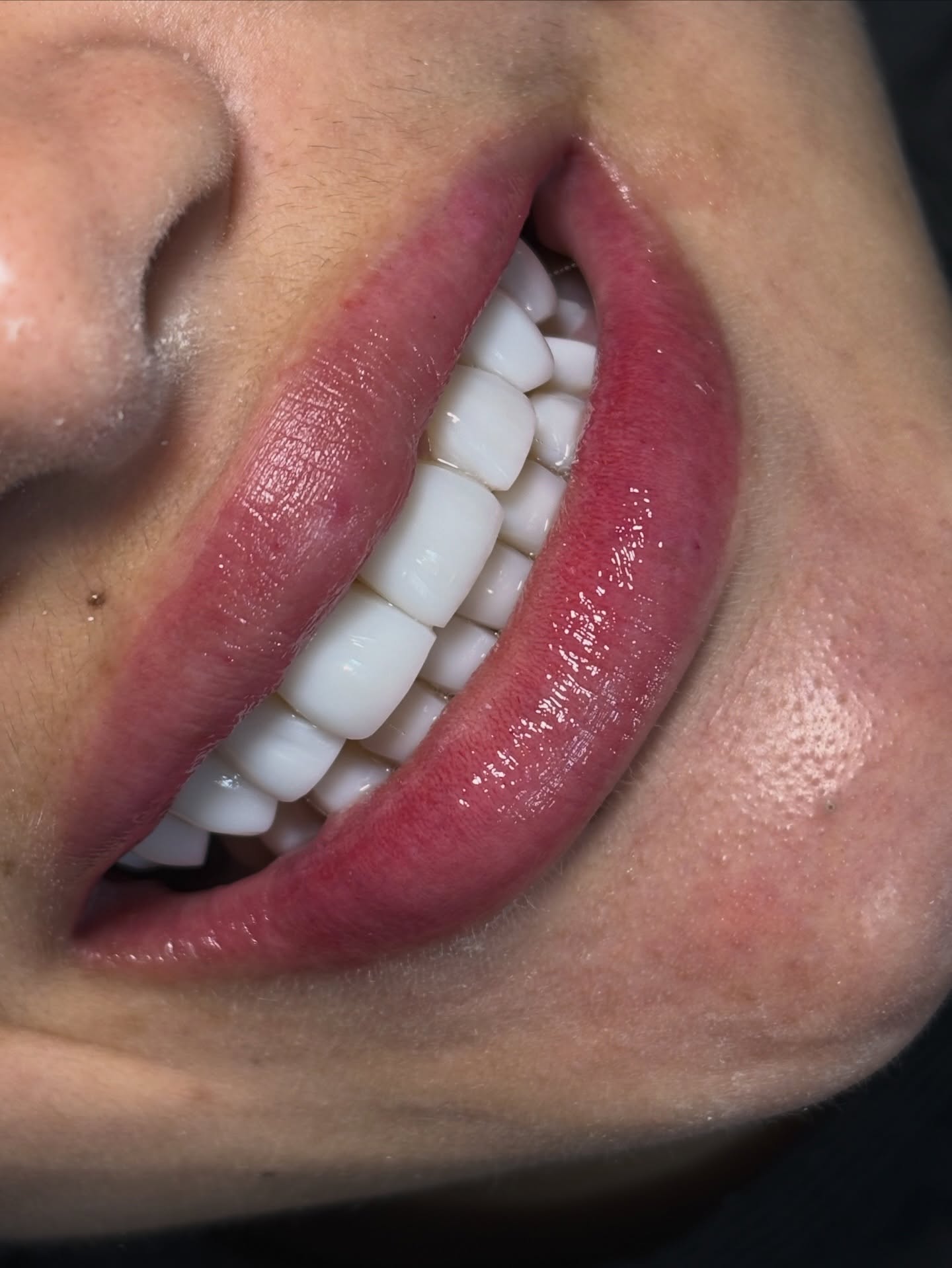 Sorriso finalizado com facetas em resina uniformes e brancas